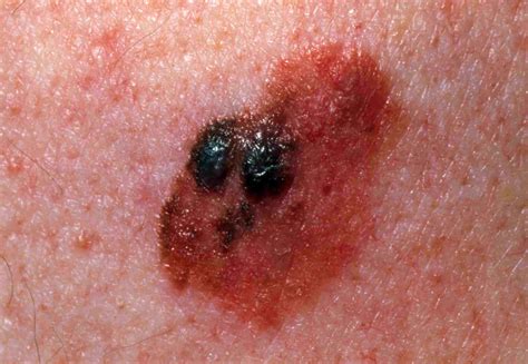 melanoma spots on face